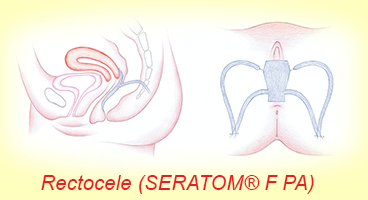 Rectocele